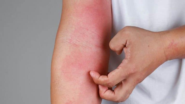 sabun dermatitis atopik